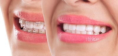 The image shows a woman with a bright smile, displaying her teeth and lips.