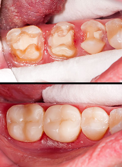 The image shows a close-up of a person s mouth with teeth that have been repaired or are in the process of being restored, with visible dental work and a tongue.