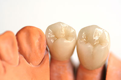 The image displays a set of artificial teeth, with two upper front teeth prominently showcasing a yellowish tint and the other teeth in various shades of brown and white.