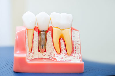 The image shows a close-up of a dental model with teeth and gums, featuring an artificial root canal treatment and a metal screw or post.