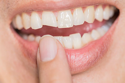 A person holding a finger to their mouth, showing a smile with braces, against a blurred background.