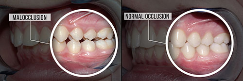 The image shows a comparison of two dental implants, one with a natural-looking gum line and the other with an artificial gum line, highlighting the difference in aesthetics.