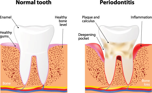 The image is a medical illustration showing the progression of periodontitis from normal tooth health to advanced bone loss, with labels indicating the different stages and their corresponding symptoms.