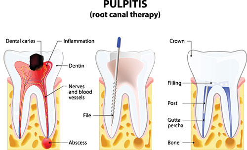 The image is a medical illustration showing a cross-section of the tooth with annotations indicating dental caries, inflammation, and the presence of bacteria. It also includes a diagrammatic representation of the pulpitis process, highlighting the stages from initial inflammation to advanced infection.