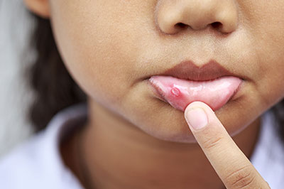 Young girl with a pimple on her chin, examining it closely with her finger.