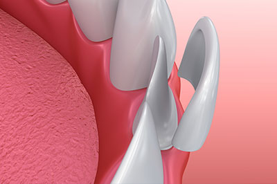 The image shows a close-up view of a dental implant with a metal fixture protruding from the gum, set against a pink background that resembles a mouth or a tongue.