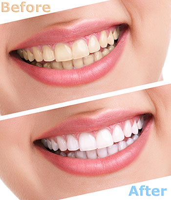 The image is a before-and-after comparison of teeth whitening, featuring two sets of human teeth with a noticeable difference in brightness and color.