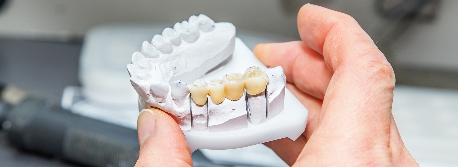 An individual is holding a partial dental implant, which appears to be a white, plastic model with teeth-like structures.