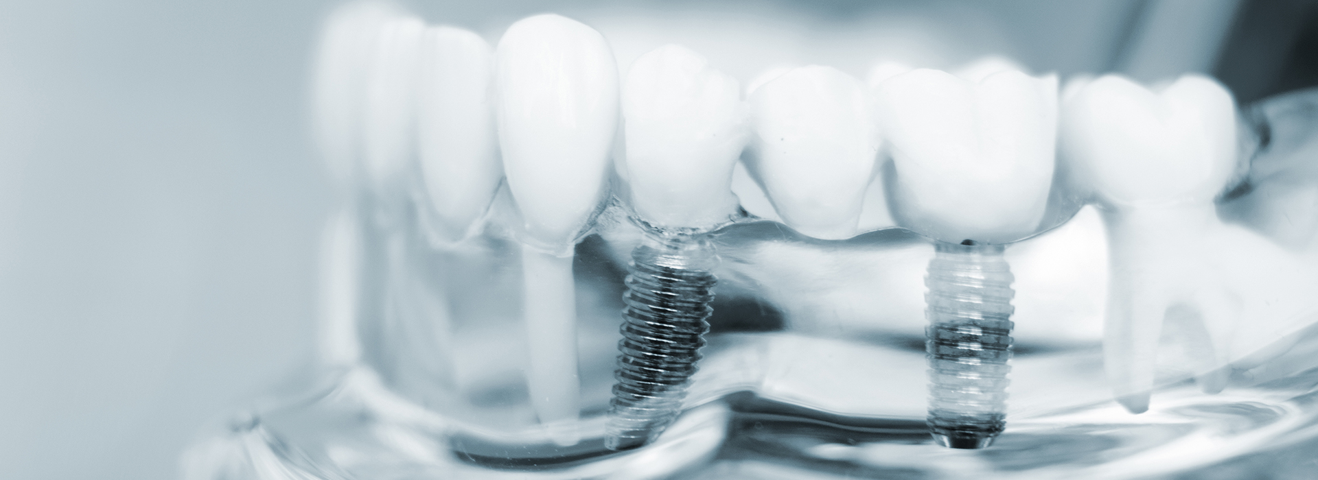 Close-up of a dental implant in progress, with a focus on the screw and surrounding area.