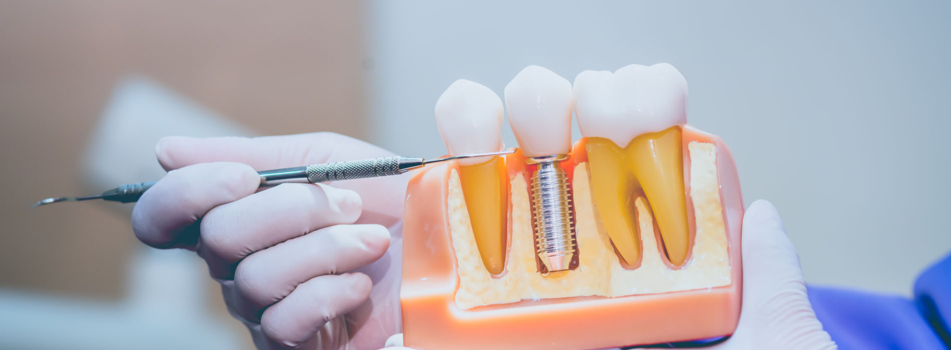 A person s hand holding a toothbrush with bristles against a clear plastic container filled with yellow dental implants.